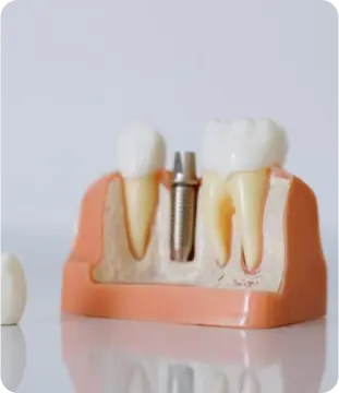 dental implants Sacramento